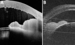 Imaging for a vascularized iris mass as sentinel manifestation of syphilis in patient with HIV infection, Spain, 2025. A) Anterior segment optical coherence tomography showing a homogeneous hyperreflective stromal lesion with keratic precipitates and inflammatory cells in the anterior chamber. B) Ultrasound biomicroscopy revealing a well-defined hyperechoic iris mass with ciliary body involvement.