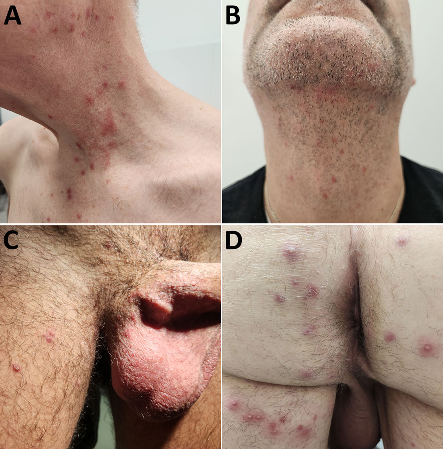 Dermatophilosis lesions in patients in cluster of suspected sexual transmission of dermatophilosis among men who have sex with men, Lyon and Paris, France, 2025–2026. A) Papular lesions of the neck and torso in patient 1. B) Folliculitis of the beard in patient 2. C) Papules of the groin and scrotum in patient 3. D) Papulopustular lesions of the buttocks during second occurrence in patient 1.
