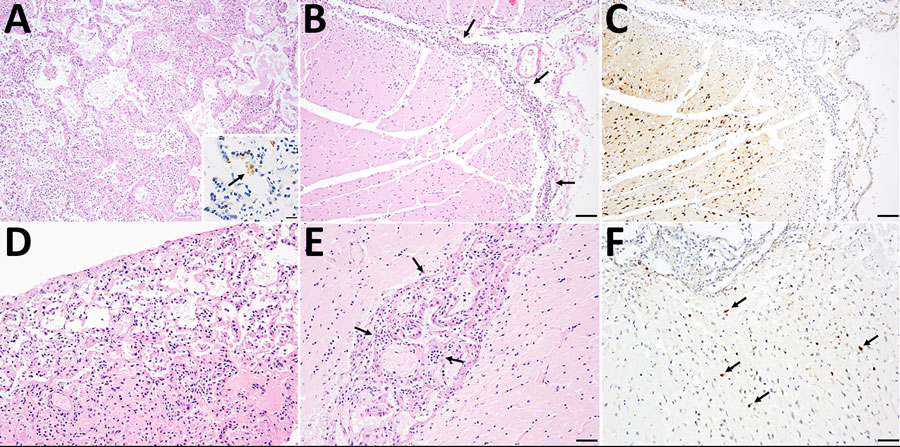 Histopathology and immunohistochemistry of lesions in a cat and rat infected with highly pathogenic avian influenza A(H5N1) virus during outbreak in backyard poultry, United States, 2025. The cat and rat were found dead on a farm in Illinois where the outbreak occurred. A–C) Cat lung (A) and brain (B, C) tissue samples showing substantial histopathology lesions likely related to HPAIV infection. A) Hematoxylin and eosin (H&E) stain of lung tissue shows bronchointerstitial pneumonia; original magnification ×10. Inset shows immunohistochemical (IHC) stain of lung demonstrates light influenza immunoreactivity in distal airway epithelium (arrow). Scale bar indicates 20 µm. B) H&E stain of brain tissue shows nonsuppurative meningoencephalitis (arrows). Scale bar indicates 100 µm. C) IHC stain of brain shows influenza immunoreactivity in cerebrocortical glial cells and neurons. Scale bar indicates 100 µm. D–F) Rat lung (D) and brain (E, F) tissue samples. D) H&E stain of rat lung tissue shows background alveolitis. Original magnification ×20. E) H&E stain of brain tissue shows nonsuppurative periventricular encephalitis (arrows). Scale bar indicates 50 µm. F) IHC of brain tissue shows influenza immunoreactivity in few periventricular neurons (arrows). Scale bar indicates 50 µm.