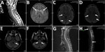 Magnetic resonance imaging (MRI) in selected patients with M. pneumoniae–related central nervous system complication in study of emergence of novel macrolide-resistant M. pneumoniae sequence type 3 subclades in children after COVID-19 pandemic, Taiwan, 2017–2024. A) Sagittal T2-weighted cervical spine MRI in patient 3, demonstrating a hyperintense lesion extending from C3 to C6 (arrow). B) Axial T2-FLAIR brain MRI of patient 5, showing a focal hyperintense lesion in the bilateral basal ganglia (arrows). C–F) Axial T2-FLAIR brain MRI scans of patient 10, revealing multiple hyperintense lesions involving the subcortical white matter of the bilateral parietal, temporal, and occipital lobes, as well as the midbrain, pons, and middle cerebellar peduncles, findings consistent with acute disseminated encephalomyelitis (arrows). G–H) Sagittal T2-weighted spine MRI of patient 10, indicating hyperintense lesions at the brainstem and at the T3 and T11 spinal levels (arrows).