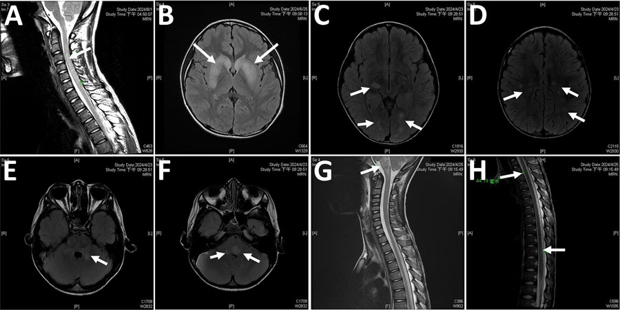 Magnetic resonance imaging (MRI) in selected patients with M. pneumoniae–related central nervous system complication in study of emergence of novel macrolide-resistant M. pneumoniae sequence type 3 subclades in children after COVID-19 pandemic, Taiwan, 2017–2024. A) Sagittal T2-weighted cervical spine MRI in patient 3, demonstrating a hyperintense lesion extending from C3 to C6 (arrow). B) Axial T2-FLAIR brain MRI of patient 5, showing a focal hyperintense lesion in the bilateral basal ganglia (arrows). C–F) Axial T2-FLAIR brain MRI scans of patient 10, revealing multiple hyperintense lesions involving the subcortical white matter of the bilateral parietal, temporal, and occipital lobes, as well as the midbrain, pons, and middle cerebellar peduncles, findings consistent with acute disseminated encephalomyelitis (arrows). G–H) Sagittal T2-weighted spine MRI of patient 10, indicating hyperintense lesions at the brainstem and at the T3 and T11 spinal levels (arrows).