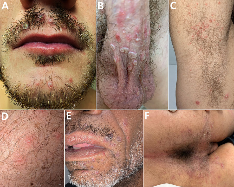 Dermatophilosis lesions in patients in cluster of suspected sexual transmission among men who have sex with men, Barcelona, Spain, December 2025–March 2026. A) Papule-pustules on the beard area; B) papulovesicular lesions on the penis and scrotum; C) pustular rash in the armpit; D) vesicle-pustules on the thigh; E) erythematous scaling papules on the beard area; F) erythematous scaling papules in the perianal region.