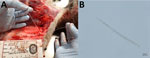 Dracunculus sp. PantanalBR nematode samples collected in investigation of Dracunculus sp. PantanalBr infection in Florida panthers and a bobcat, Florida, USA. A) Female Dracunculus sp. PantanalBR nematode was detected in subcutaneous tissues of a Florida panther (Puma concolor coryi). B) First-stage larvae of female Dracunculus sp. PantanalBR from a Florida panther. Original magnification ×200.