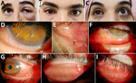 Clinical ocular findings in patients with acute external ophthalmomyiasis caused by Oestrus ovis infection after sheep exposure during Eid al-Adha, Algeria, 2025. A–C) Representative external ocular photographs show acute conjunctivitis-like findings, including palpebral edema, conjunctival hyperemia, and mucous discharge. D, E) Slit-lamp examination images show motile larvae on the corneal surface and in the lower conjunctival fornix. F–I) Slit-lamp examination images show conjunctival inflammation, including conjunctival congestion, edema, and mucous discharge. Black arrow in panel E indicates the location of an O. ovis larva.