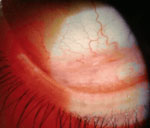 Representative video showing Oestrus ovis larvae in patient with acute external ophthalmomyiasis caused by Oestrus ovis infection after sheep exposure during Eid al-Adha, Algeria, 2025. Larvae exhibit rapid, active motility and wriggling along the surface of the inferior conjunctival fornix and on the corneal surface. The smooth corneal epithelium appeared to reduce their locomotor velocity.