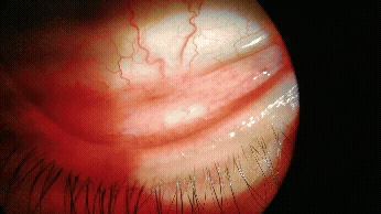 Representative video showing Oestrus ovis larvae in patient with acute external ophthalmomyiasis caused by Oestrus ovis infection after sheep exposure during Eid al-Adha, Algeria, 2025. Larvae exhibit rapid, active motility and wriggling along the surface of the inferior conjunctival fornix and on the corneal surface. The smooth corneal epithelium appeared to reduce their locomotor velocity.