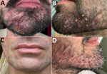 Clinical appearance of patients in study of Klebsiella aerogenes sequence type 117 facial folliculitis in men who have sex with men in France, Belgium, and the United States. A) Beard sycosis with painful purulent lesions (deep folliculitis). B) Papulopustular lesions in the beard region, consistent with both superficial and deep folliculitis. C) Pustular lesions of the mustache and beard area (superficial folliculitis). D) Multiple erythematous papules and pustules involving the right cheek and chin (superficial folliculitis).