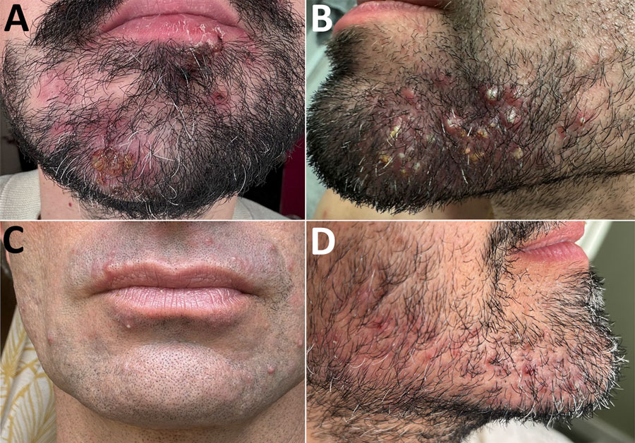 Clinical appearance of patients in study of Klebsiella aerogenes sequence type 117 facial folliculitis in men who have sex with men in France, Belgium, and the United States. A) Beard sycosis with painful purulent lesions (deep folliculitis). B) Papulopustular lesions in the beard region, consistent with both superficial and deep folliculitis. C) Pustular lesions of the moustache and beard area (superficial folliculitis). D) Multiple erythematous papules and pustules involving the right cheek and chin (superficial folliculitis).