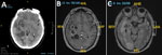 Radiologic findings from a study of autochthonous neurocysticercosis brain lesions mimicking metastatic disease, Spain. A) Noncontrast head computed tomography demonstrating multiple intra-axial lesions with surrounding vasogenic edema. B) Axial T1-weighted magnetic resonance imaging sequence with gadolinium showing multiple ring-enhancing lesions. C) Axial T2-FLAIR magnetic resonance imaging sequence revealing cystic lesions with internal nodular components suggestive of a scolex, surrounded by extensive edema.