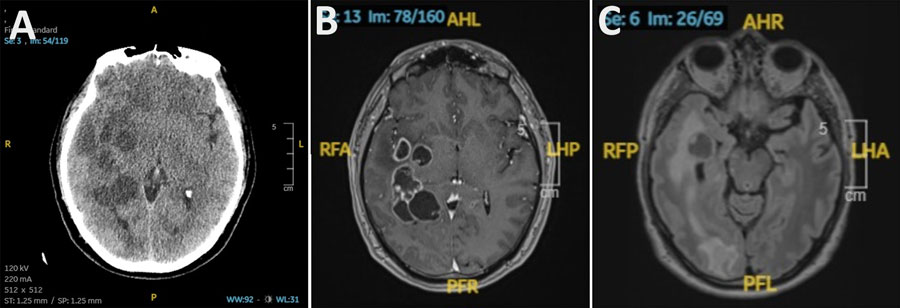 Radiologic findings from a study of autochthonous neurocysticercosis brain lesions mimicking metastatic disease, Spain. A) Noncontrast head computed tomography demonstrating multiple intra-axial lesions with surrounding vasogenic edema. B) Axial T1-weighted magnetic resonance imaging sequence with gadolinium showing multiple ring-enhancing lesions. C) Axial T2-FLAIR magnetic resonance imaging sequence revealing cystic lesions with internal nodular components suggestive of a scolex, surrounded by extensive edema.