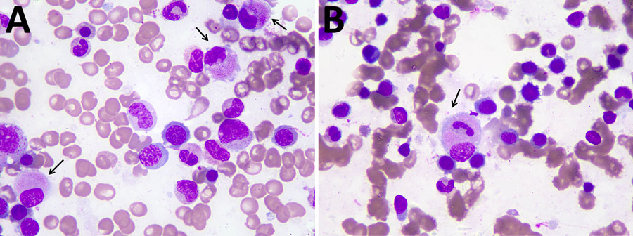 Bone marrow morphology in samples from a 79-year-old man with scrub typhus and myelodysplastic syndrome, Shandong Province, China, 2025. A) High-power view showing a macrophage with abundant cytoplasm filled with fine eosinophilic granules (arrow), morphologically resembling the typhoid cells classically described in Salmonella enterica serovar Typhi bone marrow infection. B) A macrophage exhibiting phagocytosis of a neutrophil (arrow). The findings were initially interpreted as evidence of typhoid fever but were ultimately attributed to Orientia tsutsugamushi infection, confirmed by targeted next-generation sequencing. (\Wright-Giemsa stains; original magnification ×1,000.