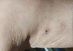 Eschar in the popliteal fossa of a 79-year-old man with scrub typhus and myelodysplastic syndrome, Shandong Province, China, 2025. A 5-mm eschar with central black necrosis and surrounding erythema was located in the left popliteal fossa. This characteristic finding of scrub typhus was initially missed because of its concealed location and was identified only after targeted next-generation sequencing of bone marrow confirmed Orientia tsutsugamushi infection, prompting a directed reexamination.