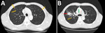 Chest computed tomography findings in a maritime container yard worker with pulmonary coccidioidomycosis, Taiwan, 2025. A) Axial lung-window images reveal multiple bilateral pulmonary nodules (orange arrows). B) A 3.0 × 2.0 cm solid mass is visible in the right upper lobe (red arrow), and right hilar lymph nodes are enlarged (green arrow).