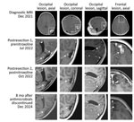 Axial, coronal, and sagittal postcontrast T1-weighted MRI images from study of neurosurgical biopsy and resection for diagnosis and treatment of Balamuthia mandrillaris amebic encephalitis, United States. Top row images show patient’s primary occipital and frontal lesions (boxes). Three weeks after resection of the first occipital lesion (second row), recurrent nodules (arrows) developed around the resection cavity. Before nitroxoline initiation, those nodules were enlarging. MRI in July 2022 (second row) showed a new, 7-mm diameter, indistinct, fluid attenuated inversion recovery–hyperintense, enhancing focus in the anterior aspect of the left superior frontal gyrus. After nitroxoline (third row), the occipital lesions retracted (arrows) and were no longer ring-enhancing. No recurrent lesions were noted at the resection site of the frontal lesion, which was resected while the patient was on multidrug therapy and 4 weeks before starting nitroxoline. Follow-up imaging 8 months after antimicrobial treatment was discontinued (fourth row), a stable, residual nodule (arrows) in the medial resection cavity remained, thought to represent gliosis. MRI, magnetic resonance imaging.
