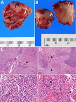 Resected occipital lesion gross and histopathology from patient in study of neurosurgical biopsy and resection for diagnosis and treatment of Balamuthia mandrillaris amebic encephalitis, United States. A) Gross pathology revealed multiple pink-tan, firm tissue fragments. B) Cut sections reveal a heterogenous, tan-pink, and soft cut surface with effacement of the white and gray matter demarcation. C, D) Hematoxylin and eosin stained sections of the brain show leptomeningeal thickening with striking perivascular lymphocytic infiltrate (C, arrow) extending into the cortical parenchyma with foci of lymphocytic infiltration into the vessel wall, consistent with vasculitis (D, arrow). The architecture of the cortical gray matter is obliterated by neuronal loss, reactive gemistocytic astrocytes and infiltration by macrophages, multinucleated giant cells, and lymphocytes (D, arrowhead). This involves the adjacent white matter with areas of parenchymal loss/liquefactive necrosis (D). Original magnification ×2 for panel C, ×10 for panel D. E, F) Many of the multinucleated giant cells (E, arrow) contain large round thick-walled parasites (F, arrow) containing granular material and an occasional inconspicuous, dot like nucleus (F, arrowhead). Original magnification ×40 for panels E and F. Occasional structures resembling engulfed organisms are seen in the parenchyma (D–F).