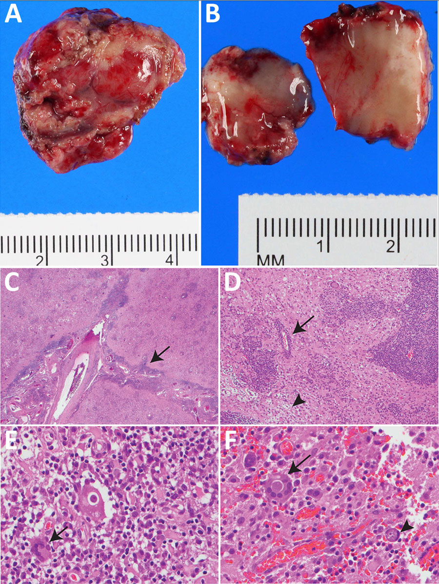 Resected occipital lesion gross and histopathology from patient in study of neurosurgical biopsy and resection for diagnosis and treatment of Balamuthia mandrillaris amebic encephalitis, United States. A) Gross pathology revealed multiple pink-tan, firm tissue fragments. B) Cut sections reveal a heterogenous, tan-pink, and soft cut surface with effacement of the white and gray matter demarcation. C, D) Hematoxylin and eosin stained sections of the brain show leptomeningeal thickening with striking perivascular lymphocytic infiltrate (C, arrow) extending into the cortical parenchyma with foci of lymphocytic infiltration into the vessel wall, consistent with vasculitis (D, arrow). The architecture of the cortical gray matter is obliterated by neuronal loss, reactive gemistocytic astrocytes and infiltration by macrophages, multinucleated giant cells, and lymphocytes (D, arrowhead). This involves the adjacent white matter with areas of parenchymal loss/liquefactive necrosis (D). Original magnification ×2 for panel C, ×10 for panel D. E, F) Many of the multinucleated giant cells (E, arrow) contain large round thick-walled parasites (F, arrow) containing granular material and an occasional inconspicuous, dot like nucleus (F, arrowhead). Original magnification ×40 for panels E and F. Occasional structures resembling engulfed organisms are seen in the parenchyma (D–F).