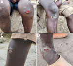 Irregular appearance of cutaneous ulcer lesions from patients in study of Haemophilus ducreyi bacteria causing cutaneous ulcer outbreak in children, Sierra Leone, December 2025. A) Lesions over the knee. B) Lesions below the knee. C) Lesions on the mid-lateral aspect of the leg. D) Lesions at the ankle.