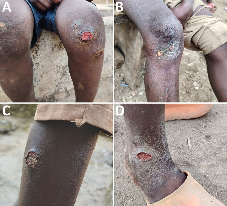 Irregular appearance of cutaneous ulcer lesions from patients in study of Haemophilus ducreyi bacteria causing cutaneous ulcer outbreak in children, Sierra Leone, December 2025. A) Lesions over the knee. B) Lesions below the knee. C) Lesions on the mid-lateral aspect of the leg. D) Lesions at the ankle.