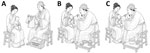 Principal variolation methods described in historical medical texts in study of variolation techniques, medical explanations, and dissemination in late Imperial China. A) Smallpox garment/blanket method, in which a healthy child was exposed to clothing or bedding used by a patient with smallpox. The aim was to induce infection that was expected to be milder and to confer subsequent protection. B) Smallpox lymph method, in which a cotton plug soaked with fluid from fully mature pustules was inserted into one nostril of the recipient. A silk thread was tied to the cotton plug to ensure that it could be safely removed. C) Smallpox scab method (dry inoculum method), in which powdered smallpox scabs were insufflated into the child’s nostril through a slender tube while the mother stabilized the child. Illustrations were hand-drawn reconstructions by an author (S.G.) according to descriptions in historical medical texts from China.
