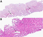 Liver biopsy images from study of a fatal infection with dengue virus and avian orthoavulavirus 1 in traveler from Saudi Arabia, 2025. A) Sirius red stain showing normal architecture without any fibrosis. Solid arrow indicates centrilobular vein; dashed arrow indicates portal tract. Original magnification ×100. B) Hematoxylin and eosin stain showing extensive parenchymal necrosis; all hepatocytes of the lobule are necrotic. Lobules contain few inflammatory cells. Solid arrow indicates centrilobular vein. Original magnification ×200.