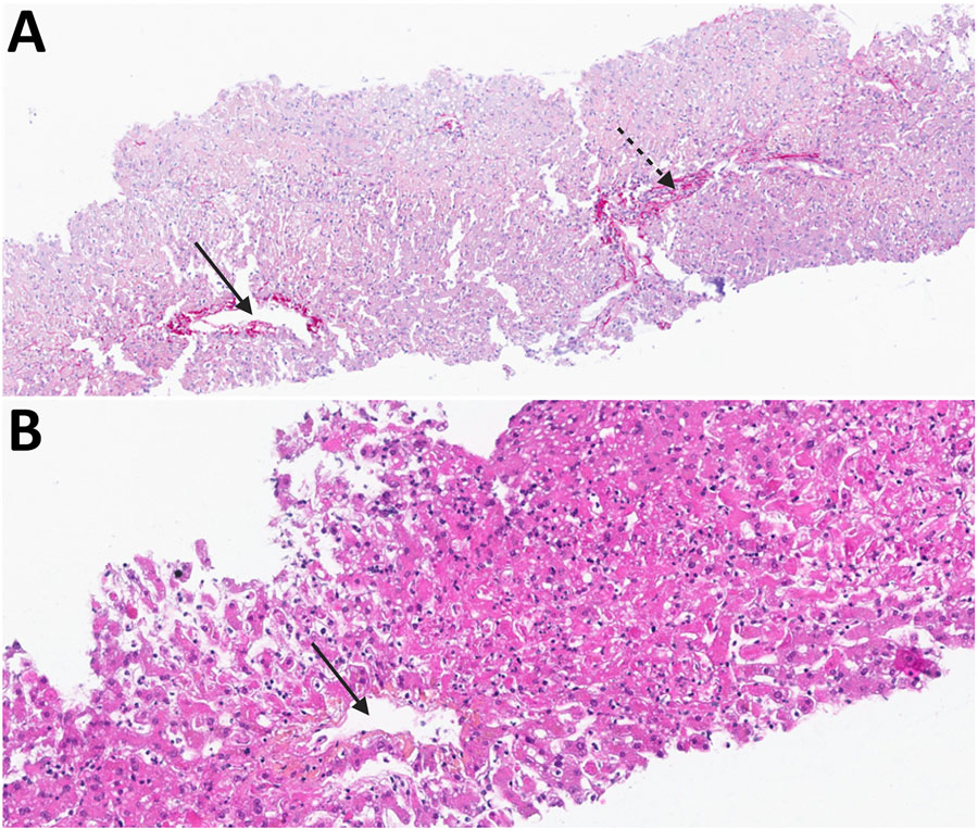Liver biopsy images from study of a fatal infection with dengue virus and avian orthoavulavirus 1 in traveler from Saudi Arabia, 2025. A) Sirius red stain showing normal architecture without any fibrosis. Solid arrow indicates centrilobular vein; dashed arrow indicates portal tract. Original magnification ×100. B) Hematoxylin and eosin stain showing extensive parenchymal necrosis; all hepatocytes of the lobule are necrotic. Lobules contain few inflammatory cells. Solid arrow indicates centrilobular vein. Original magnification ×200.