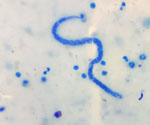 Dirofilaria asiatica microfilaria isolated from a 2-year-old girl from Kalutara District, Sri Lanka, stained with methylene blue. The microfilaria has a rounded anterior end with 2 cephalic nuclei (visible at lower right) and a curved tail. Original magnification ×1,000.