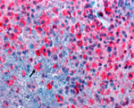 Acanthamoeba immunoassay from study of Acanthamoeba encephalitis and chronic lymphocytic leukemia, United States. Arrow indicates free-living amebic trophozoites of small to medium size that have rare double-walled cysts and show immunoreactivity to an Acanthamoeba spp. immunoassay.