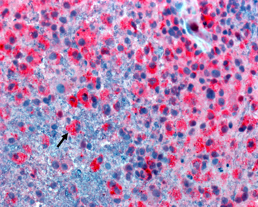Acanthamoeba immunoassay from study of Acanthamoeba encephalitis and chronic lymphocytic leukemia, United States. Arrow indicates free-living amebic trophozoites of small to medium size that have rare double-walled cysts and show immunoreactivity to an Acanthamoeba spp. immunoassay.