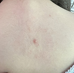 Erythema migrans–like skin lesion at the site of a tick bite on patient’s upper back in study of southern tick–associated rash illness in pediatric patient, New York, USA, 2025.