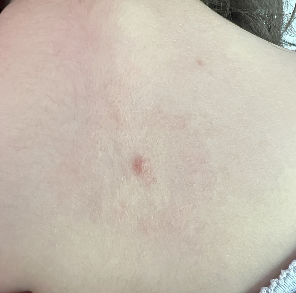 Erythema migrans–like skin lesion at the site of a tick bite on patient’s upper back in study of southern tick–associated rash illness in pediatric patient, New York, USA, 2025.