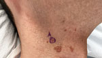 Image from a case report of condylomas caused by human papillomavirus on extragenital cutaneous site in immunocompetent man, New York, USA, 2025. Brown, clustered, verrucous-to-mamillated papules are shown on the right lateral neck. The circled lesion underwent biopsy.