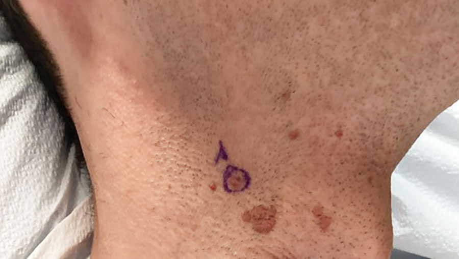 Image from a case report of condylomas caused by human papillomavirus on extragenital cutaneous site in immunocompetent man, New York, USA, 2025. Brown, clustered, verrucous-to-mamillated papules are shown on the right lateral neck. The circled lesion underwent biopsy.