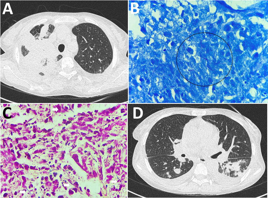 Histopathologic and radiologic findings in renal transplant recipient with disseminated trimethoprim/sulfamethoxazole–resistant nocardiosis, India. A) High-resolution computed tomography of the chest before treatment, showing right-upper-lobe consolidation with adjacent passive atelectasis and a left pleural effusion. B) Lung biopsy, Fite stained, showing weakly acid-fast, branching, beaded filamentous bacteria (circle). Original magnification ×1,000. C) Lung biopsy, hematoxylin and eosin stained, showing suppurative inflammation (arrows). Original magnification ×400. D) High-resolution computed tomography of the chest 6 months after treatment, showing resolution of the consolidation with residual pulmonary fibrosis.