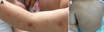 Photographs of rash from study of fatal Rickettsia parkeri rickettsiosis in immunocompromised pediatric patient, Georgia, USA, 2025. A) Eschar on left upper extremity; B) rash on patient’s torso.
