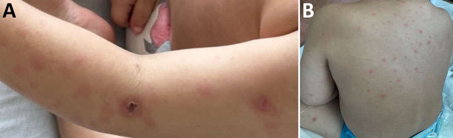 Photographs of rash from study of fatal Rickettsia parkeri rickettsiosis in immunocompromised pediatric patient, Georgia, USA, 2025. A) Eschar on left upper extremity; B) rash on patient’s torso.