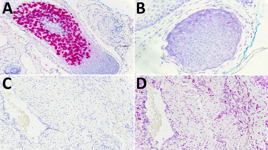 In situ hybridization (RNAscope) (5) for trichodysplasia spinulosa polyomavirus (TSPyV) in tissue samples, United States. A) Positive control tissue from a case of trichodysplasia spinulosa with staining for TSPyV. Original magnification ×200. B) peptidylprolyl isomerase B (PPIB) RNA probe staining on the same control tissue. Original magnification ×400. C) A representative case of inflammatory dermatosis with no staining for TSPyV RNA. Original magnification ×200. D) PPIB RNA probe staining on the same tissue in (C). Original magnification ×200.