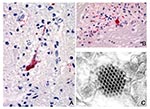 Thumbnail of A). Positive immunostaining of EV71 antigens in neuron and neuronal process. Original magnification, X158. B). Positive immunostaining of EV71 antigens in necrotic area. Original magnification, X158. C). An array of picornavirus particles in a neuron (electron micrograph).