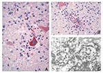 Thumbnail of A). Positive immunostaining of Japanese encephalitis antigens in neuron and neuronal process. Original magnification, X158. B). Positive immunostaining of Japanese encephalitis antigens in necrotic area. Original magnification, X158. C). Flavivirus particles (arrowheads) in isolates from mouse brain (electron micrograph).