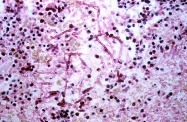 Biopsy of foot lesion: area of extended dermal necrosis with inflammatory infiltration. In the center, PAS- (periodic acid-Schiff stain) positive septate hyphae branching at an acute angle (x400).