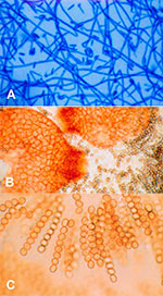 Thumbnail of A) Neocosmospora vasinfecta after 4 days' subculture on Sabouraud agar (lactophenol cotton blue stain, x400). B) N. vasinfecta perithecial ascomata after 4 weeks on oatmeal agar with lupine stem (x160). C) Asci with ascospores of N. vasinfecta (x400).