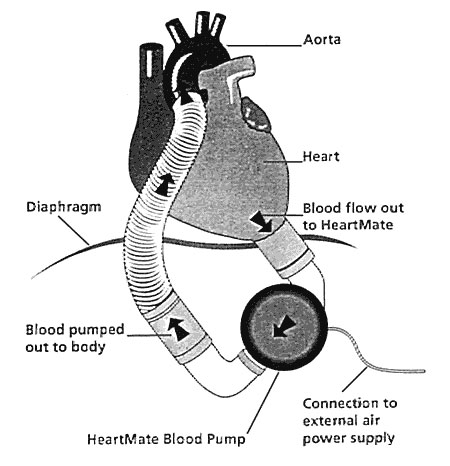 Implantable left ventricular assist device.