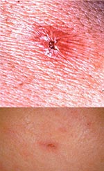 Thumbnail of Upper: Typical eschar of Japanese Spotted Fever. Lower: Small and shallow eschar on admission, which disappeared in a few days.
