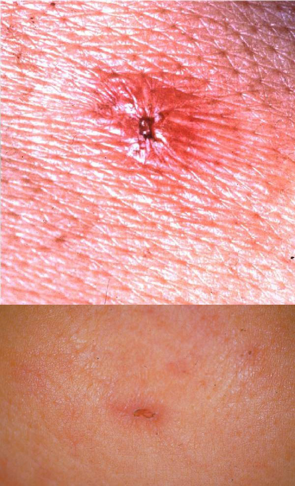 Upper: Typical eschar of Japanese Spotted Fever. Lower: Small and shallow eschar on admission, which disappeared in a few days.