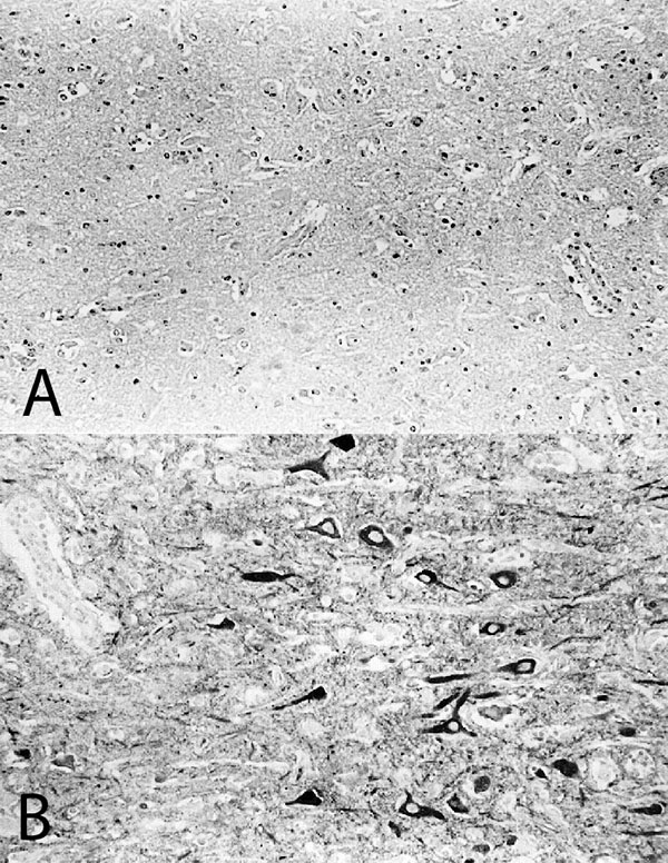 Immunohistologic analysis of consecutive brain sections from the cerebral cortex of horse #215 with A) the monoclonal antibody Bo18, specific for the p38/p39 BDV-protein and B) a rabbit monospecific serum, specific for the p24 BDV-protein. Immunoreactive neurons are only detected with the p24-specific antiserum. Papa-nicolaou-counterstain, x130.