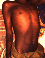 Thumbnail of Rash in a man with epidemic typhus in Burundi.