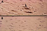 Thumbnail of Immunocytochemical staining demonstrating Chlamydia pneumoniae in fibrolipid plaque from coronary artery atheroma. Panel A illustrates positive staining of foam cells in the plaque with the C. pneumoniae—specific monoclonal antibody TT-401. Panel B shows negative staining of the adjacent section using normal ascites fluid as the control.