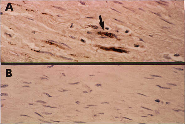 Immunocytochemical staining demonstrating Chlamydia pneumoniae in fibrolipid plaque from coronary artery atheroma. Panel A illustrates positive staining of foam cells in the plaque with the C. pneumoniae—specific monoclonal antibody TT-401. Panel B shows negative staining of the adjacent section using normal ascites fluid as the control.