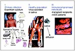 Thumbnail of Stages of the natural history of HHV-6 infection: I. Primary infection occurs in infants, may result in exanthem subitum (rash on the child's chest), and spreads to organs. Question marks denote sites where HHV-6 spread is likely but not proven. II. In healthy infants and adults, HHV-6 is present in a latent or persistent form in lymph nodes and is produced asymptomatically in salivary glands and shed in saliva, the most probable route of transmission. III. HHV-6 infection/reactivat