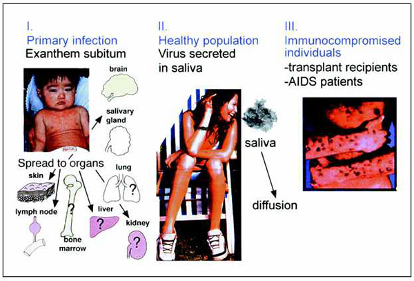 Stages of the natural history of HHV-6 infection: I. Primary infection occurs in infants, may result in exanthem subitum (rash on the child's chest), and spreads to organs. Question marks denote sites where HHV-6 spread is likely but not proven. II. In healthy infants and adults, HHV-6 is present in a latent or persistent form in lymph nodes and is produced asymptomatically in salivary glands and shed in saliva, the most probable route of transmission. III. HHV-6 infection/reactivation occurs in