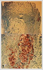 Thumbnail of Early-(A) and late- stage (B) disease histopatho- logic sections of the dermis stained for acid-fast bacilli (AFB) from a patient with a Mycobacterium ulcerans infection. In A, arrows indicate necrosis of adipose tissue distant from the location of AFB, and in B, the arrow indicates predominance of extracellular bacilli and microcolonies. Patients' samples were obtained from the study conducted in Côte d'Ivoire (12). (Photos courtesy of National Center for Infectious Diseases, CDC,